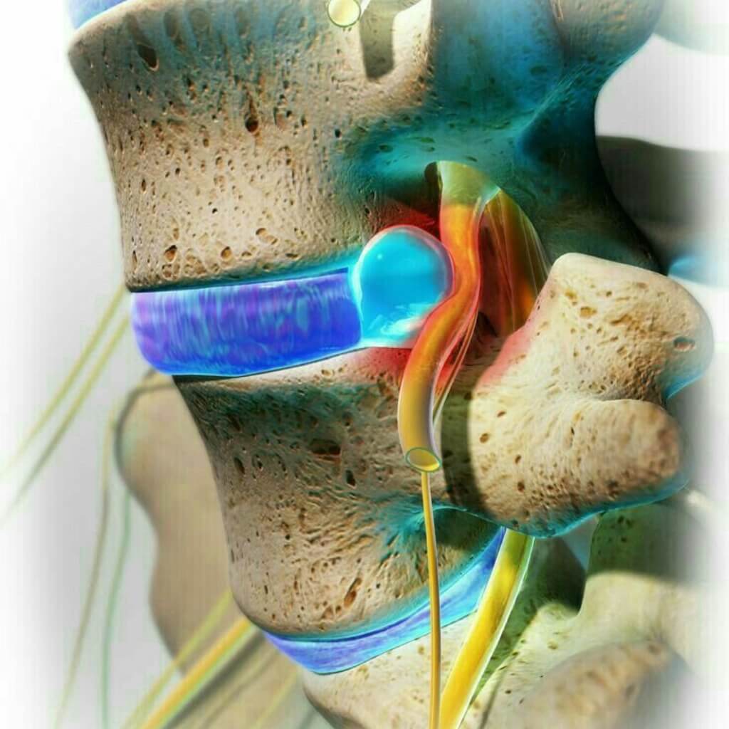 Hernia de disco