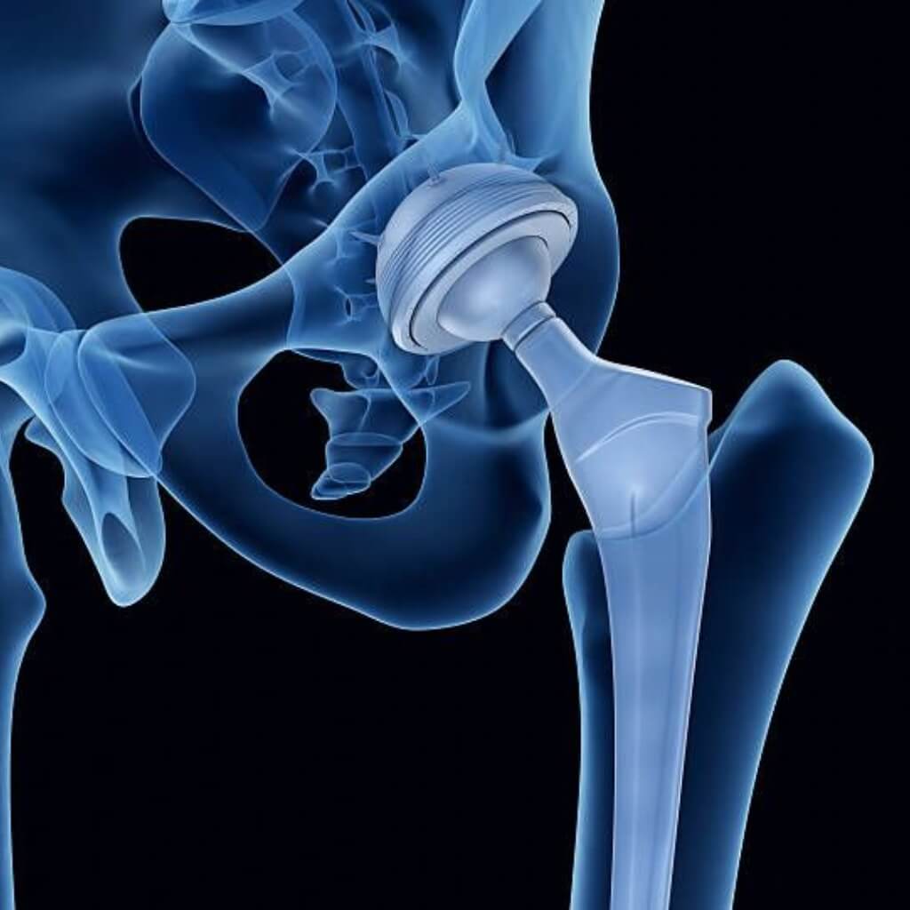 Protesis de cadera Dr. Hazael Vallejo Guerrero