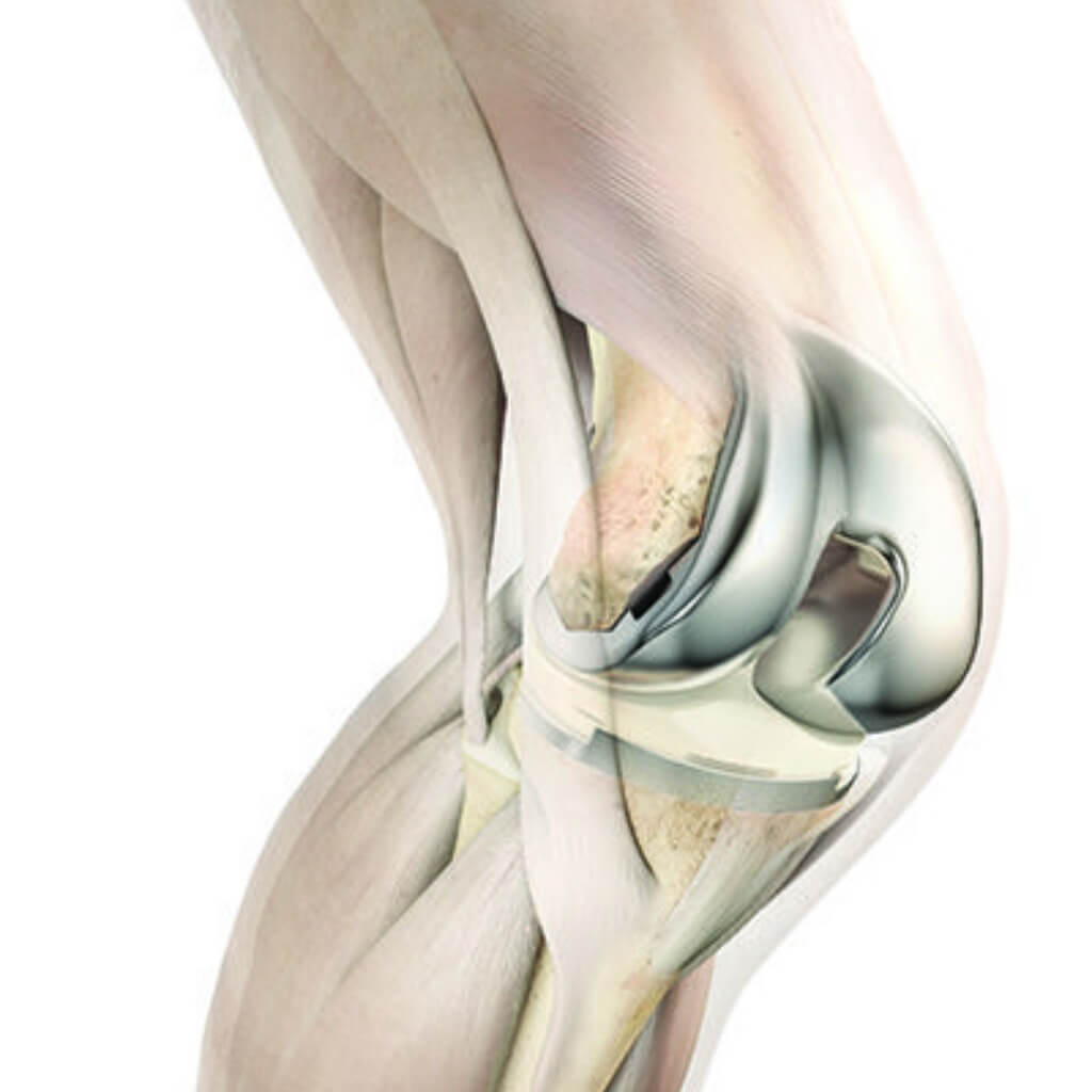 Protesis de rodilla Dr. Hazael Vallejo Guerrero