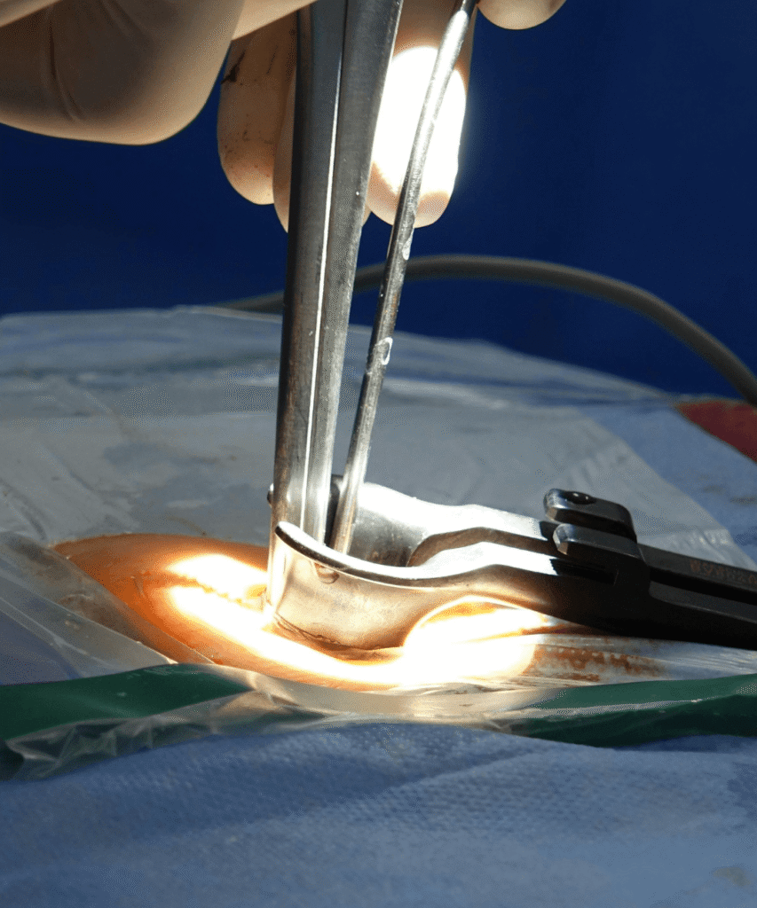 Cirugia endoscopica de columna