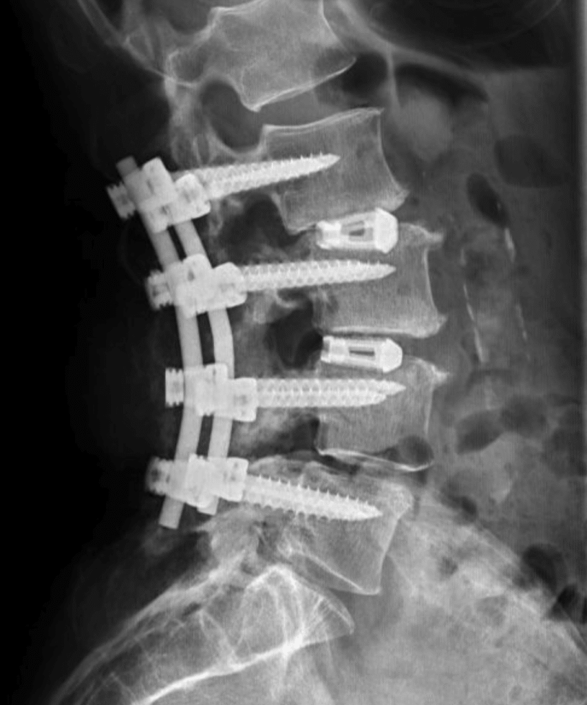 Percutanea