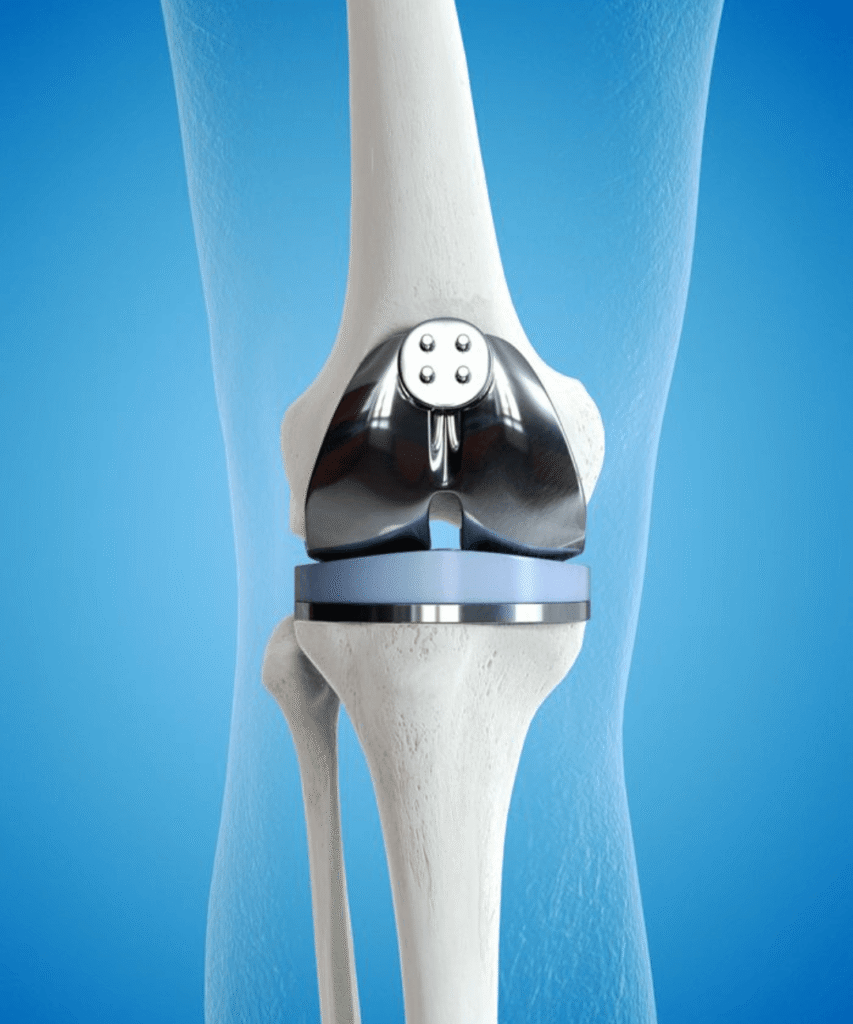 Protesis rodilla 1